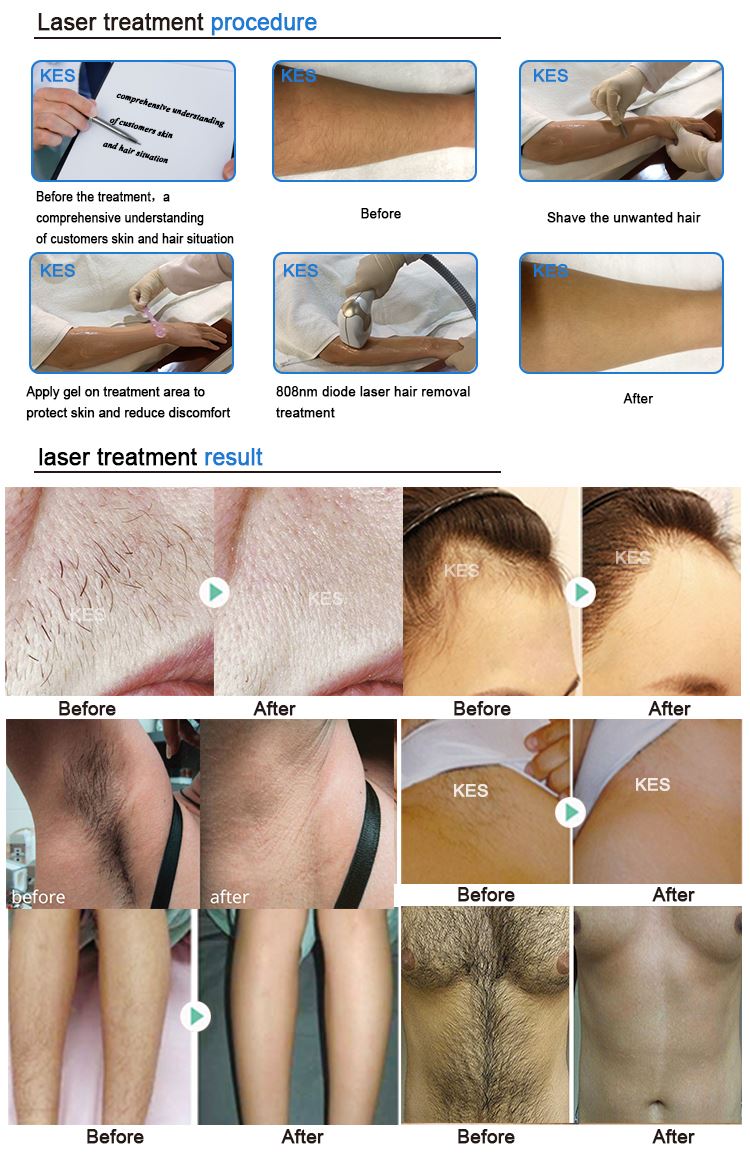 diode laser (2)